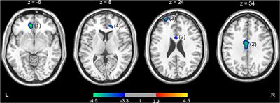 PET Hypometabolism of the Prefrontal-Cingulate Cortices in Internet Gaming Disorder